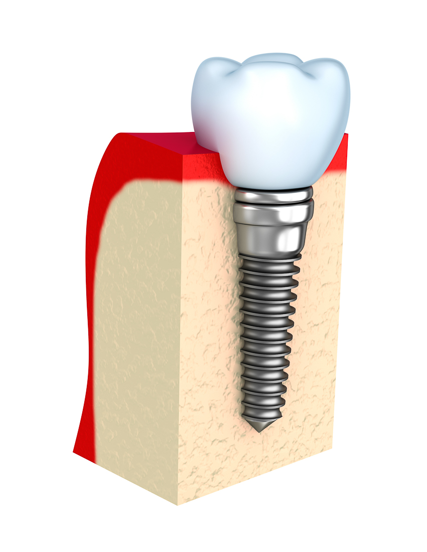 IMPLANT INSERTION SURGERY