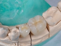 Laborator-Tehnica-Dentara-Dinti Portelan Pe Implant