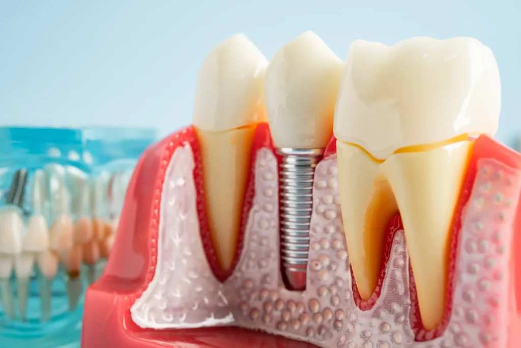 un singur implant dentar