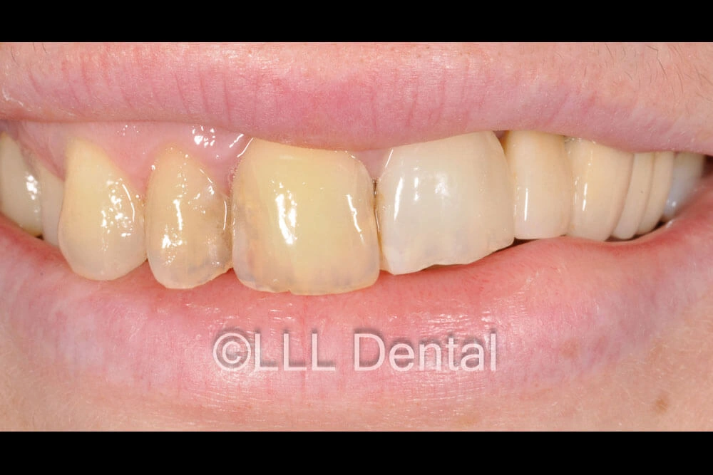 fatete ziconiu before