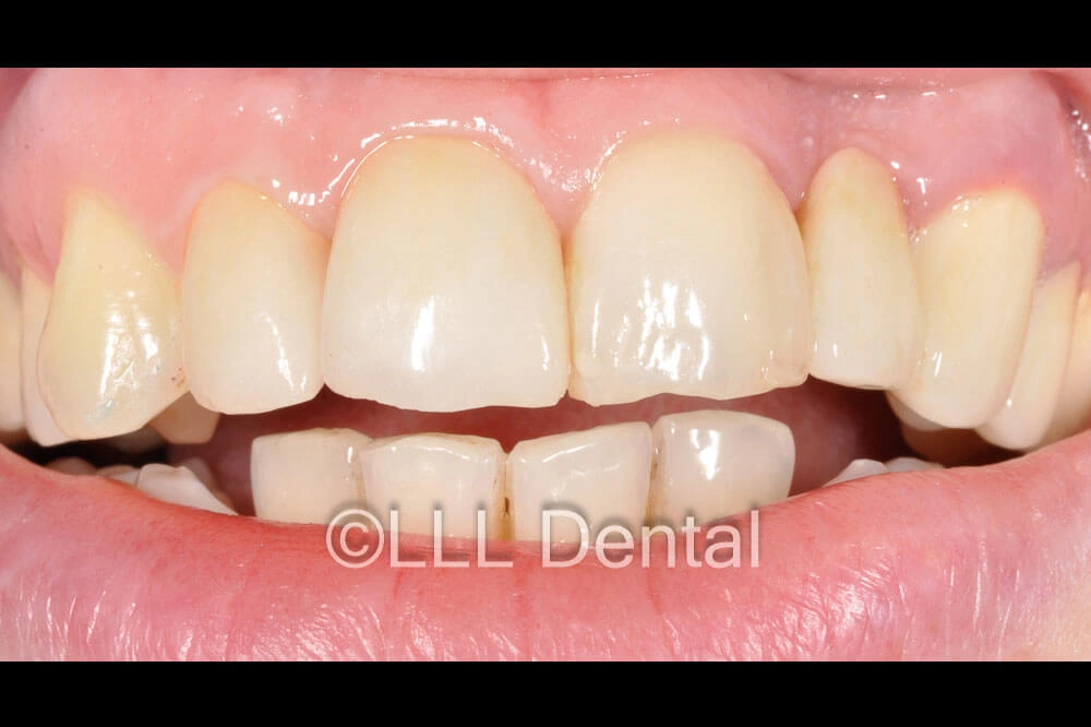 fatete zirconiu after