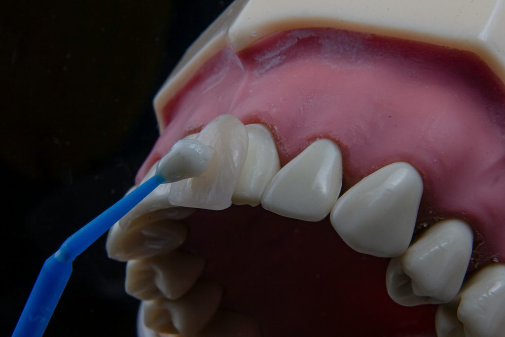 fațetă dentară