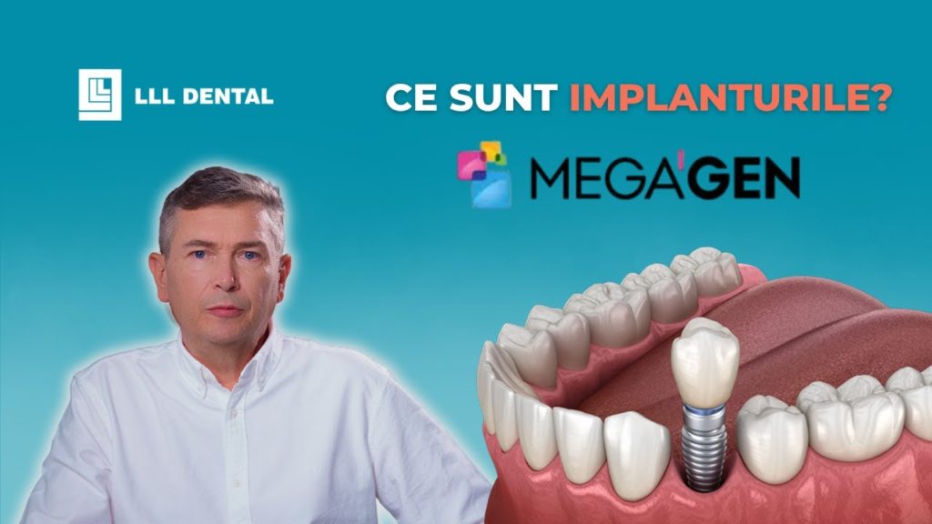 Vezi cum folosim implanturile Megagen la clinica LLL