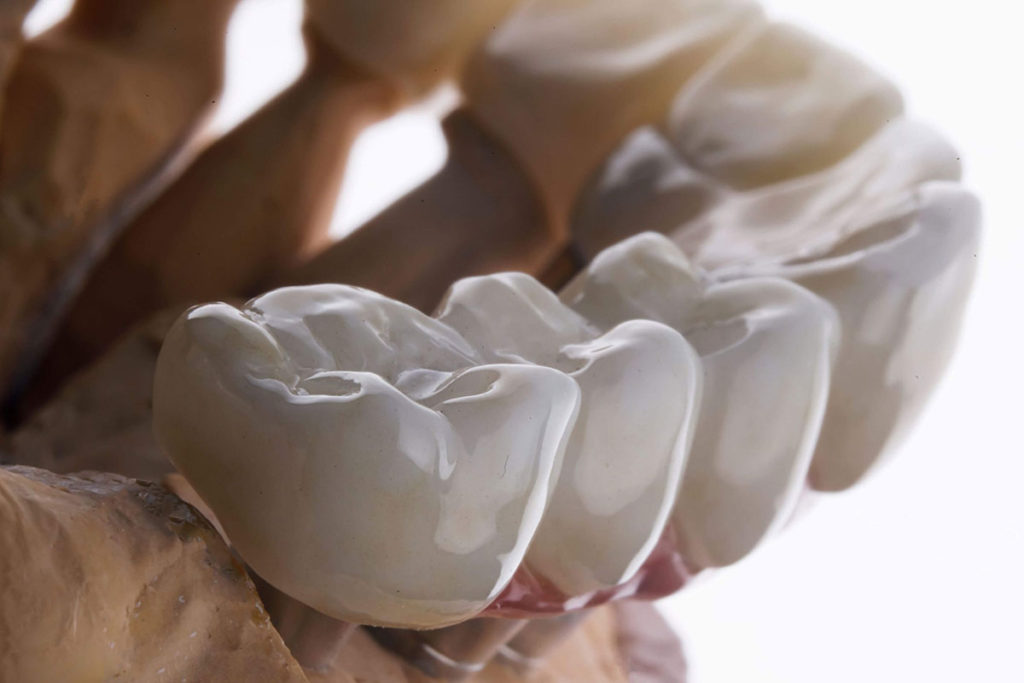 coroana dentara metalo ceramica