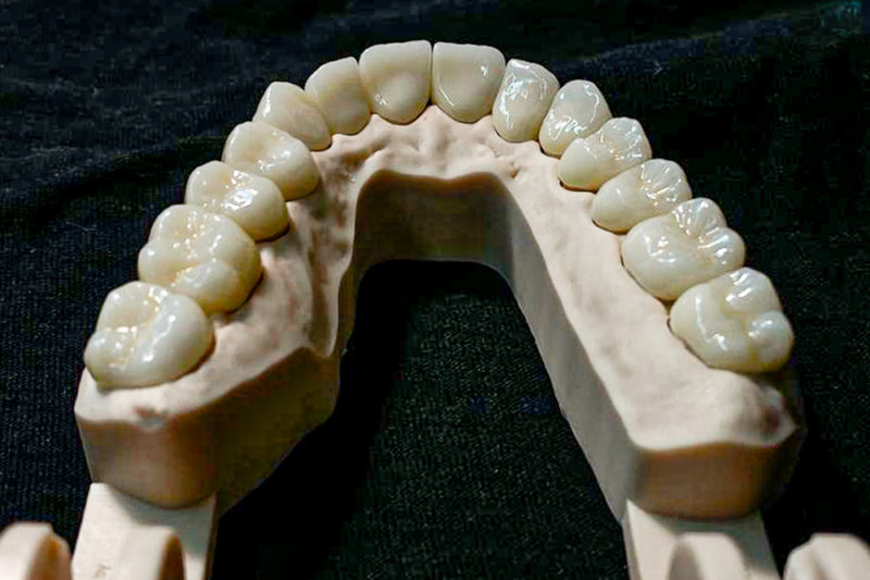 coroane din ceramica dentara presata