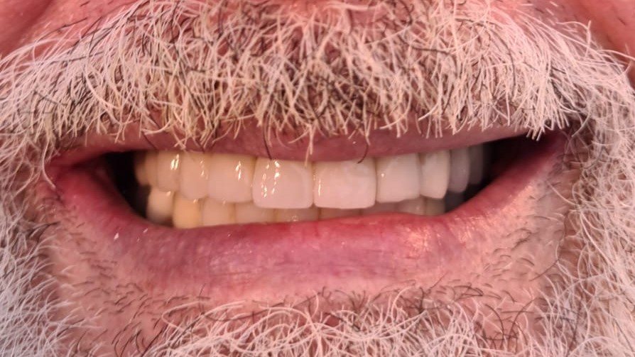 dinti refacuti la lll dental