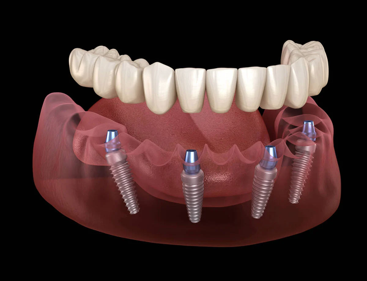 Implanturile dentare all on 4 si all on 6