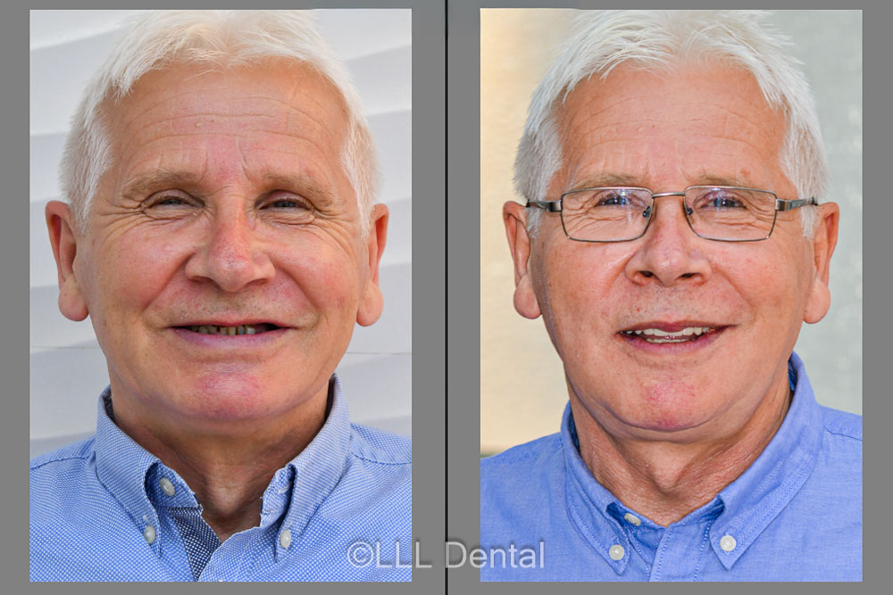 before and after dinti ficsi in 24 de ore