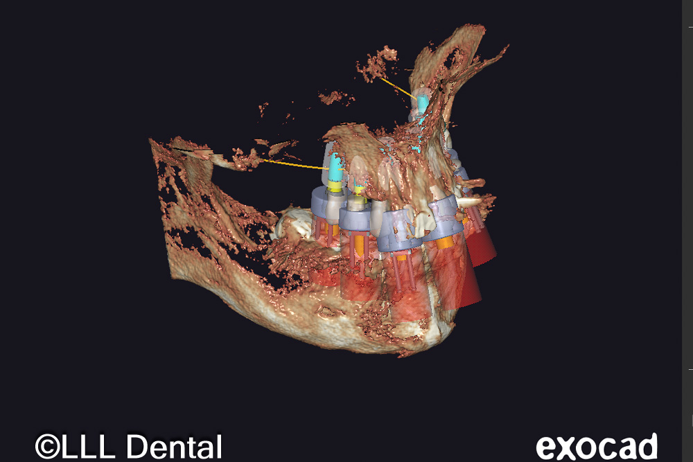 planificare digitala dantura fixa