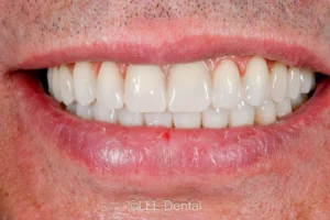 După: dantură fixă pe implanturi (All-on-X), arcada superioară și inferioară, la LLL Dental