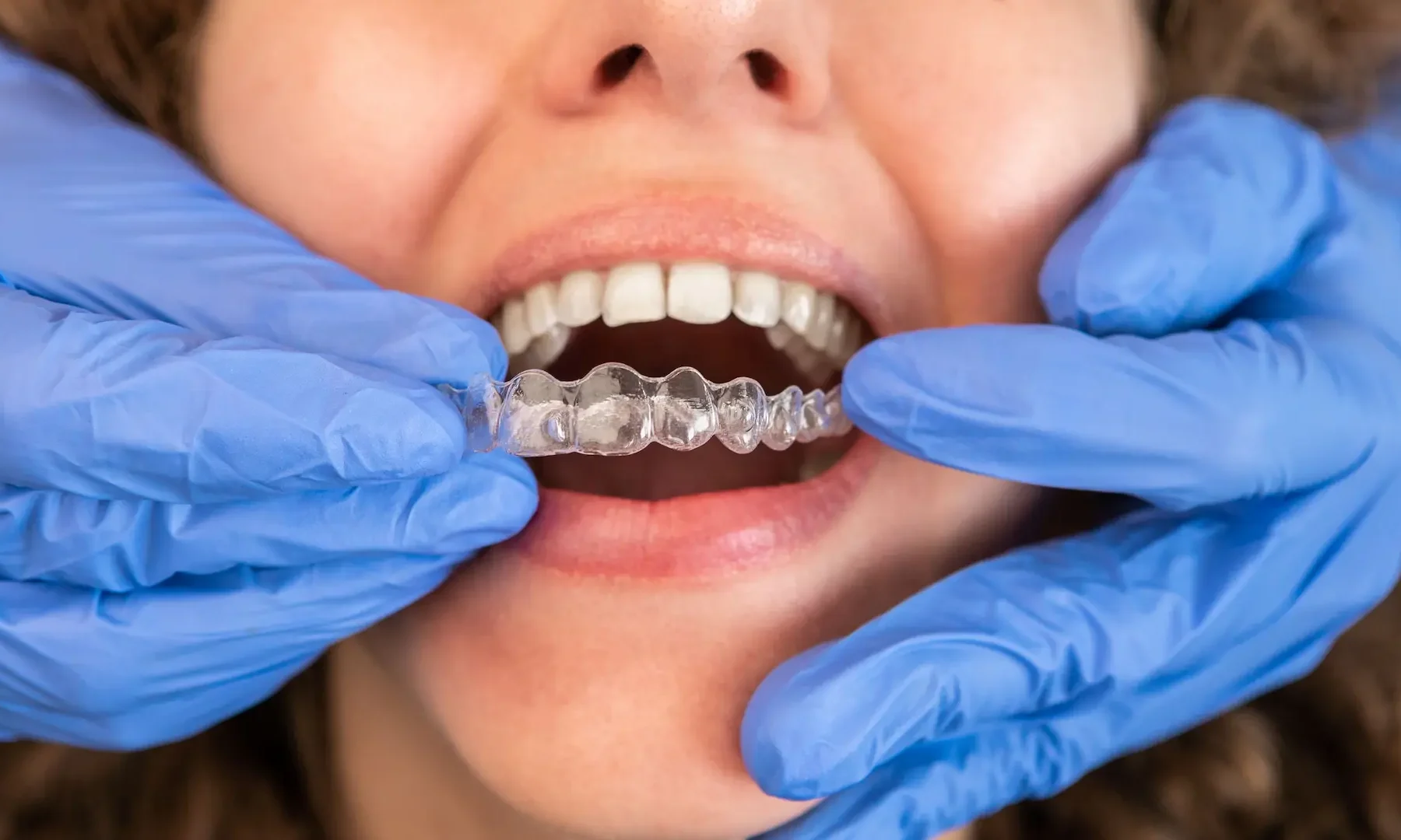 aparat dentar invizibil