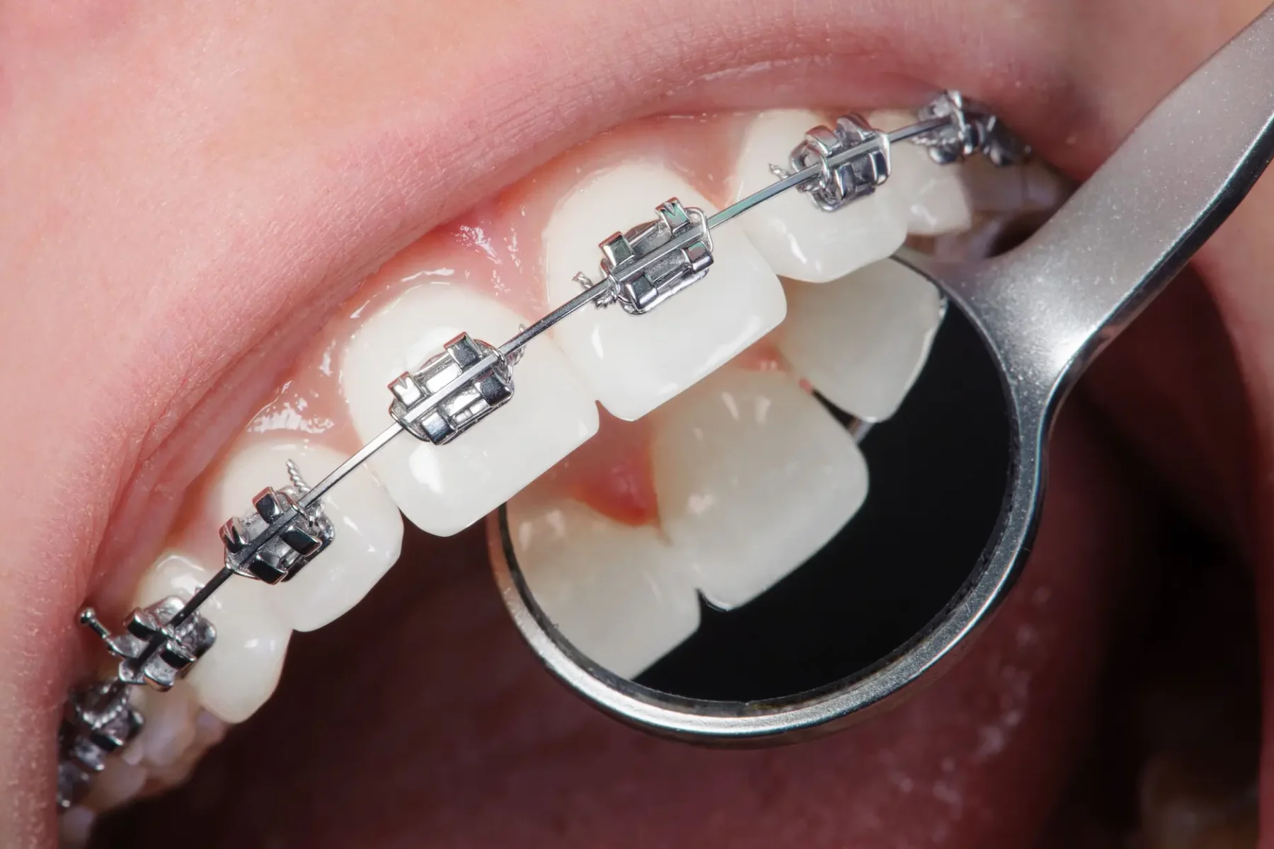 aparat dentar metalic