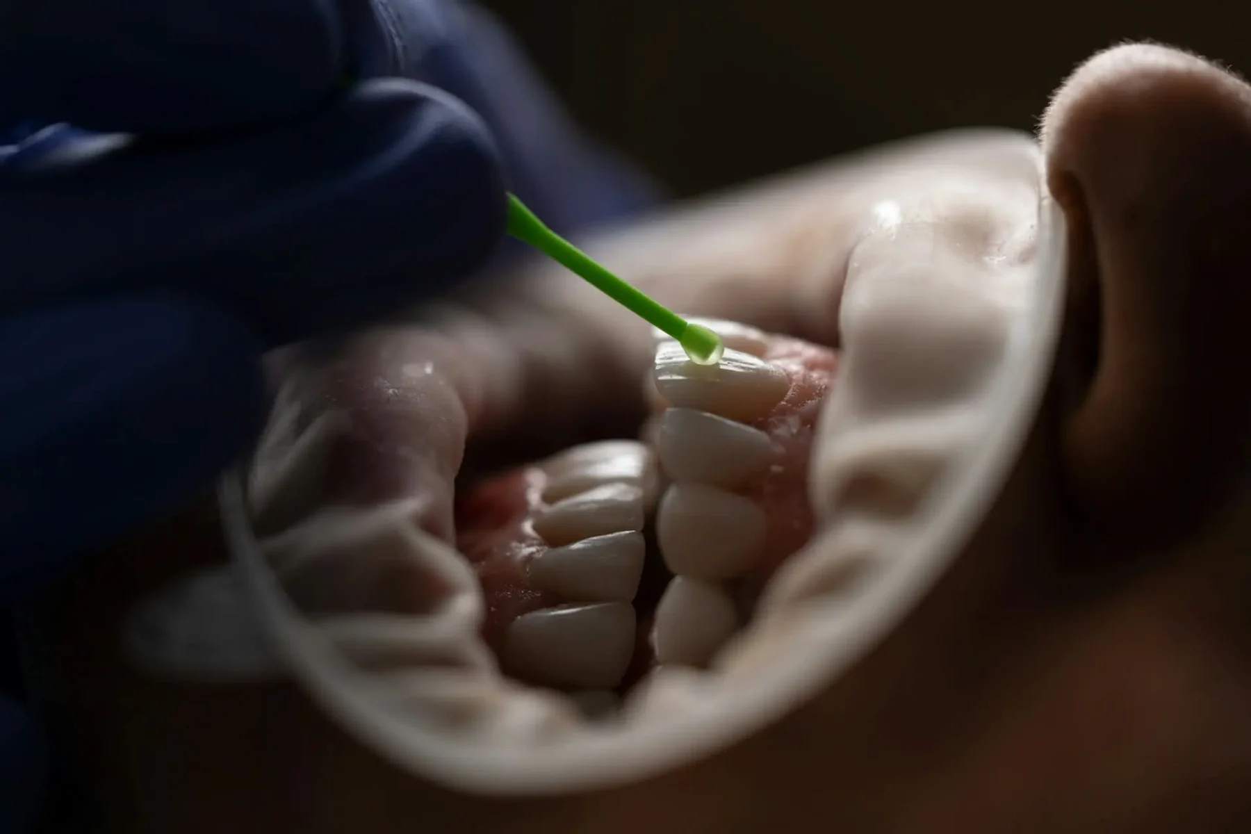 aplicare fatete dentare pentru toata gura