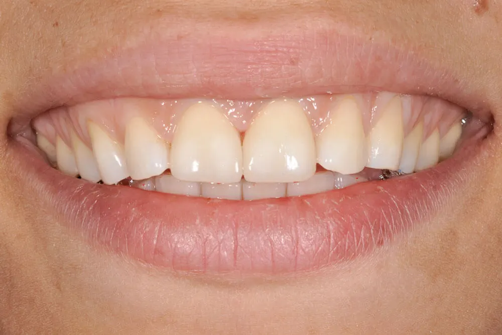 FATETE EMAX NATURAL before