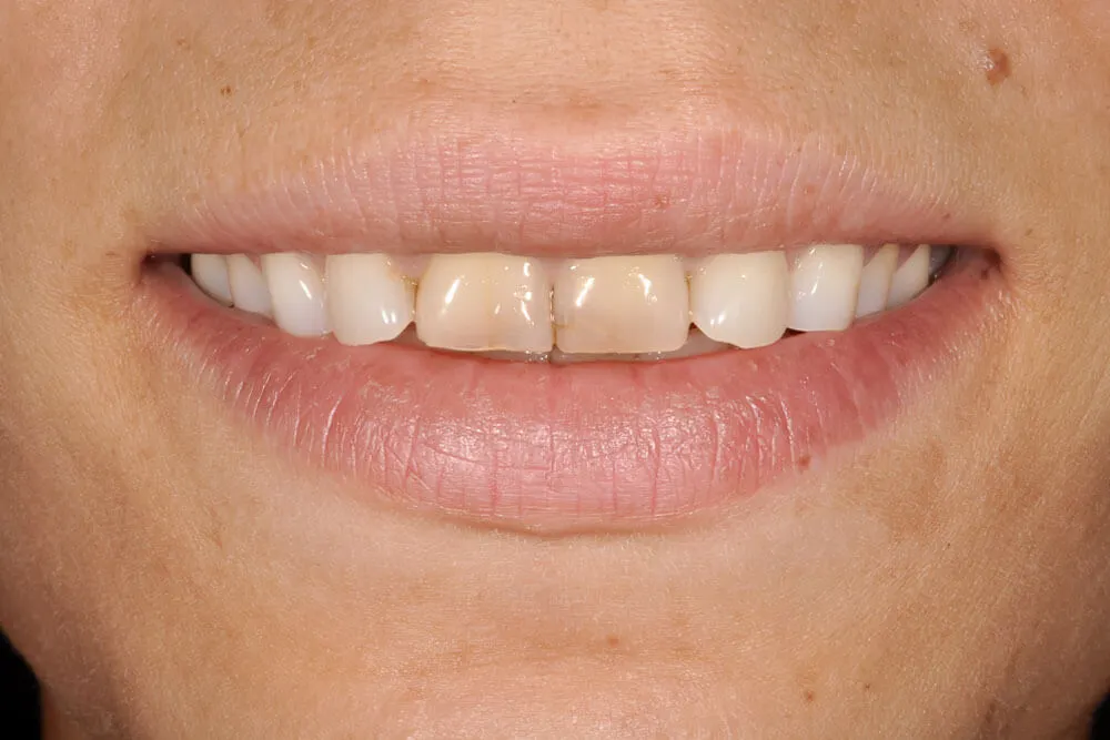 FATETE EMAX NATURAL Before