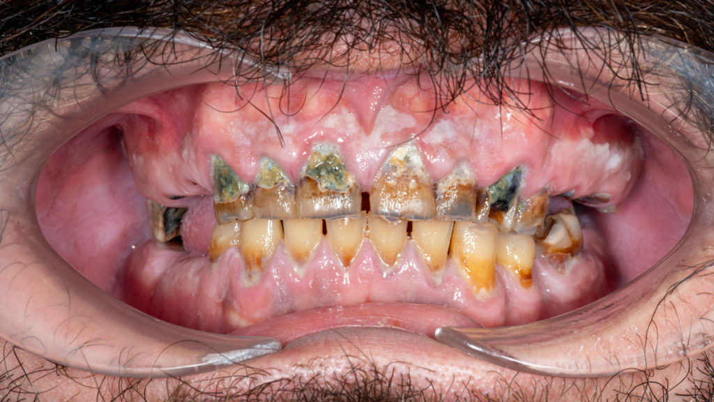 caz before dinti ficsi