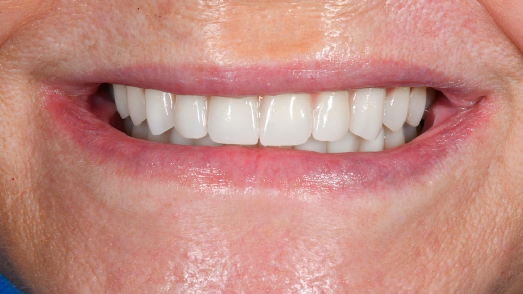 caz after dinti ficsi