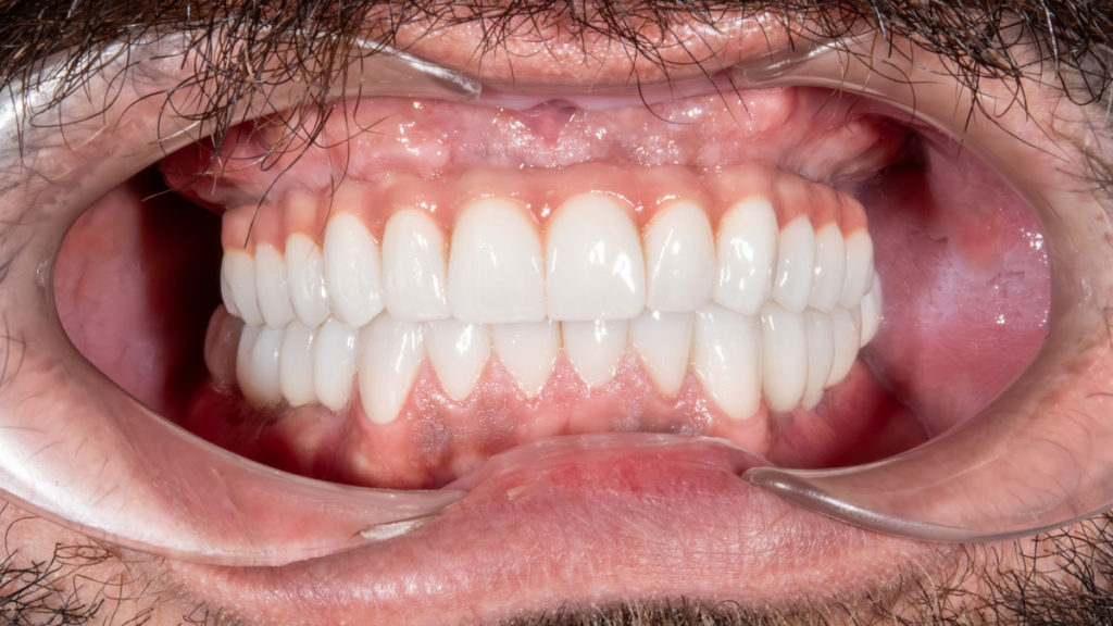 caz after dinti ficsi