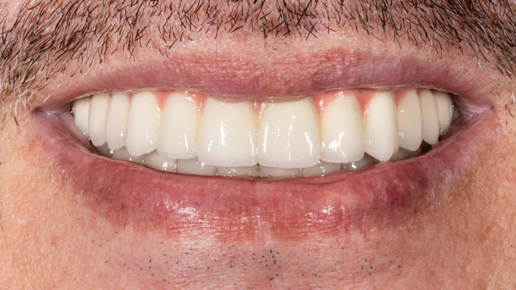 pacient dupa dinti ficsi