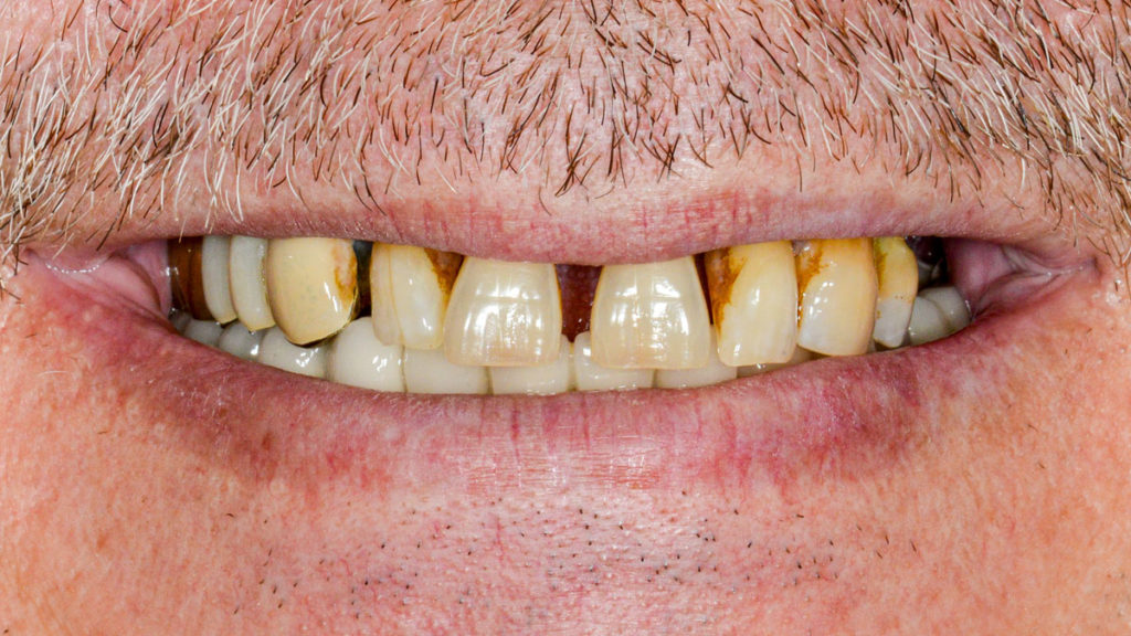 pacient inainte de dinti ficsi