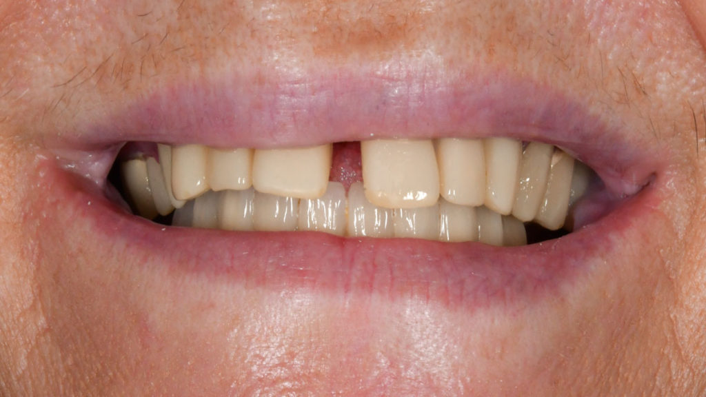 caz before dinti ficsi