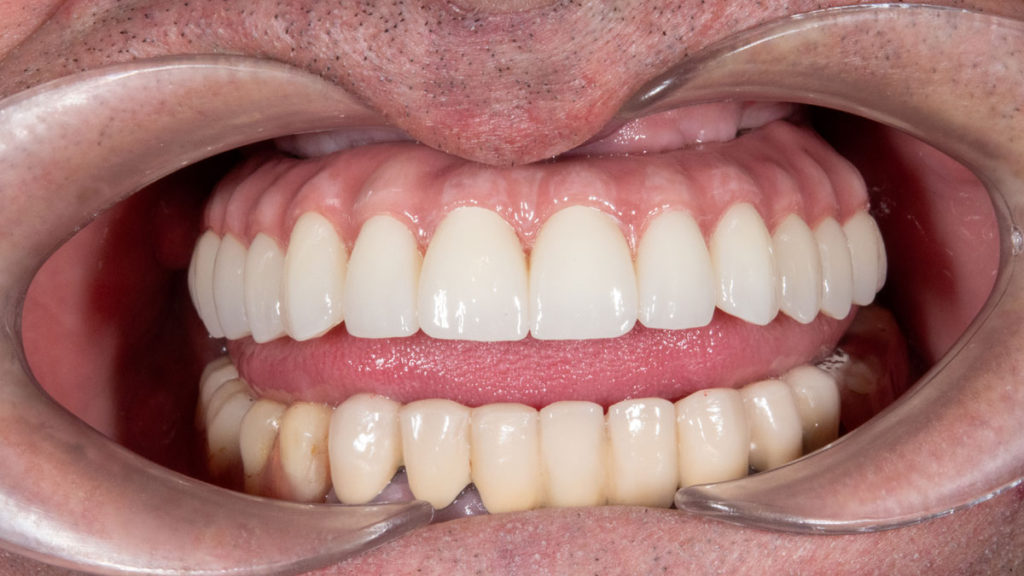 caz after implant dentar dinti ficsi