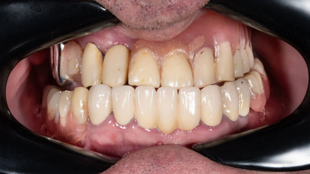 caz before dinti ficsi