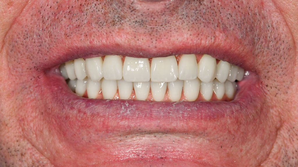 caz after dantura fixa