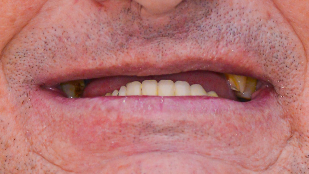 caz before dantura fixa