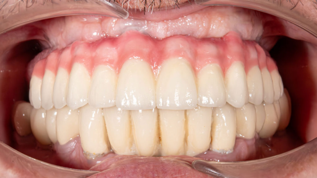 caz after dinti ficsi in 24 de ore