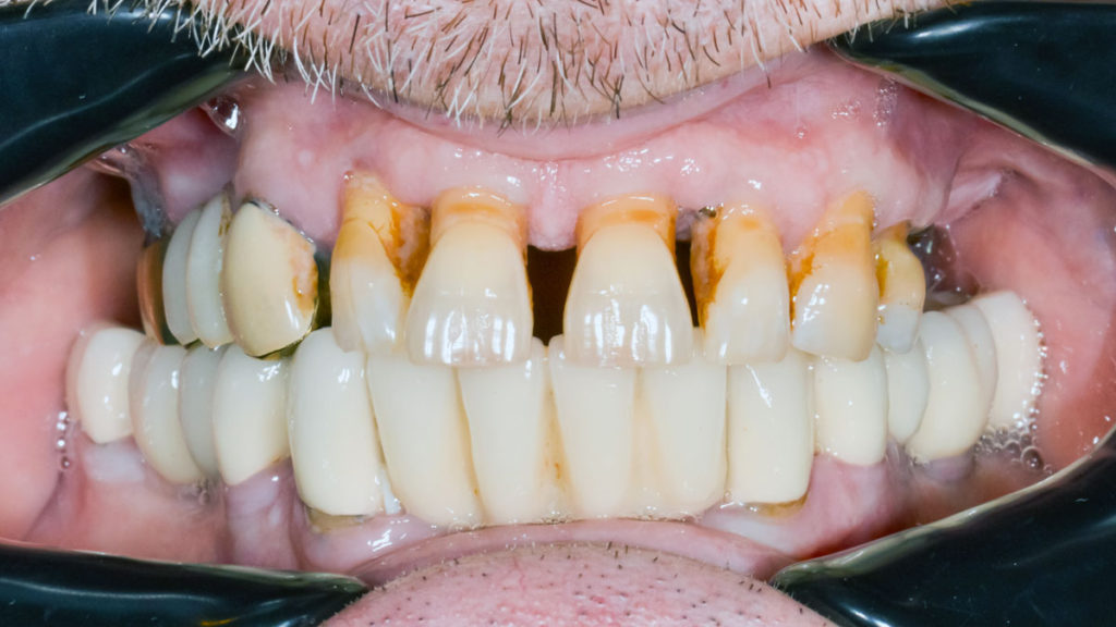 caz before dinti ficsi in 24 de ore