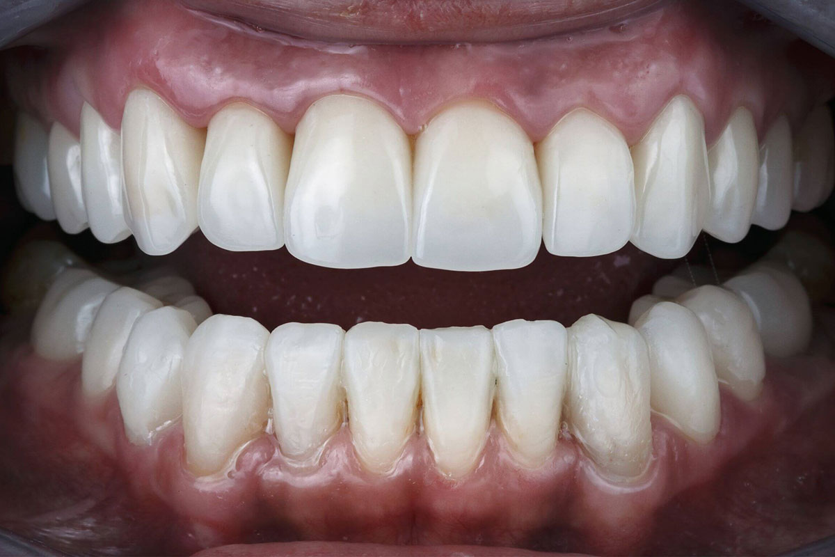 Coroana integral ceramica: avantaje | LLL Dental