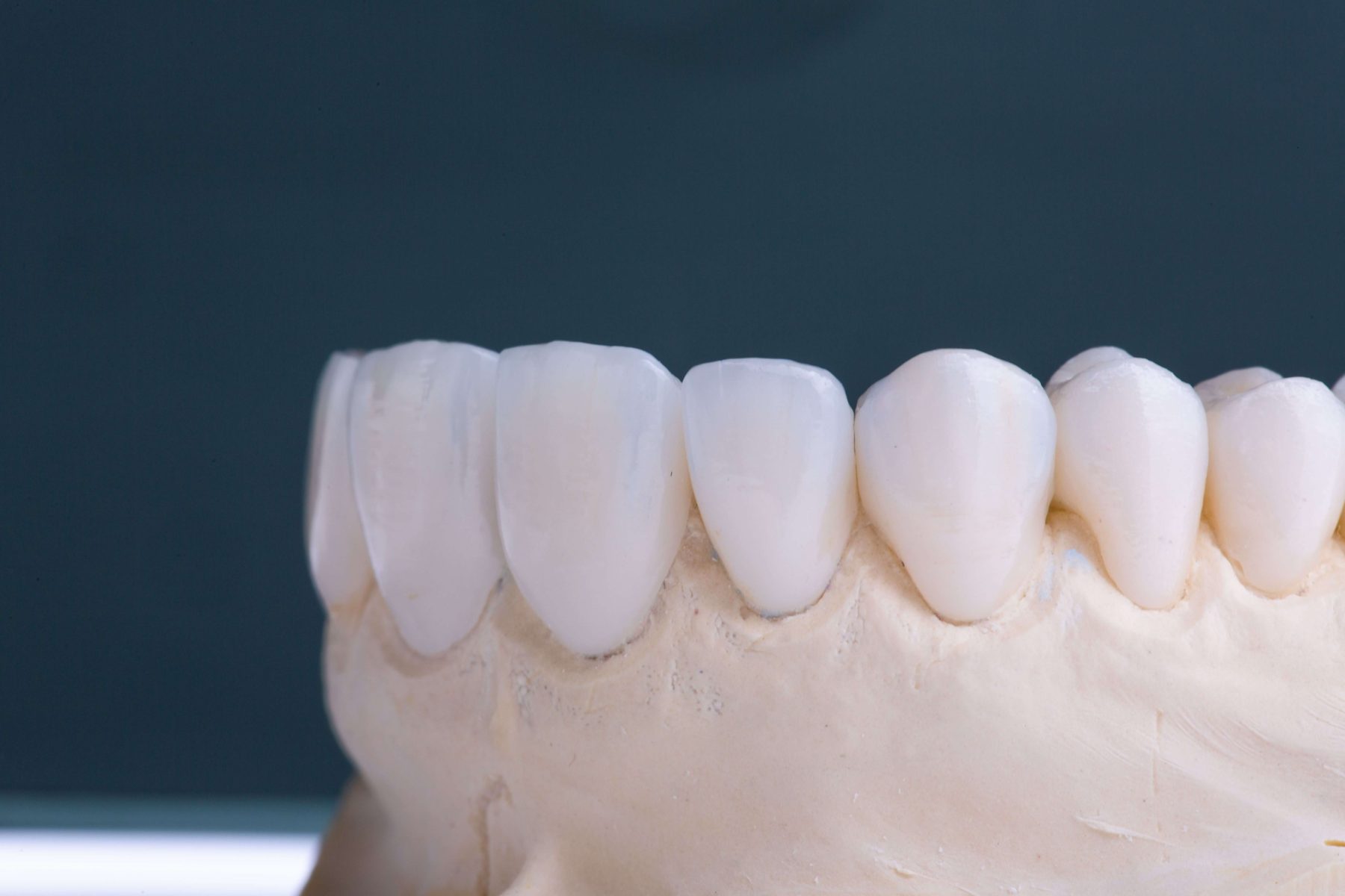 coroanele dentare