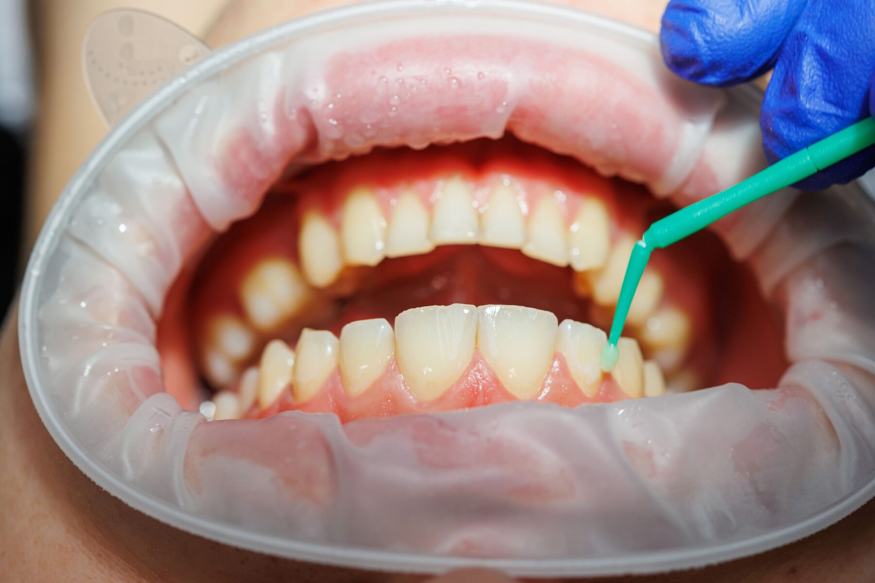 de ce se inflameaza gingia