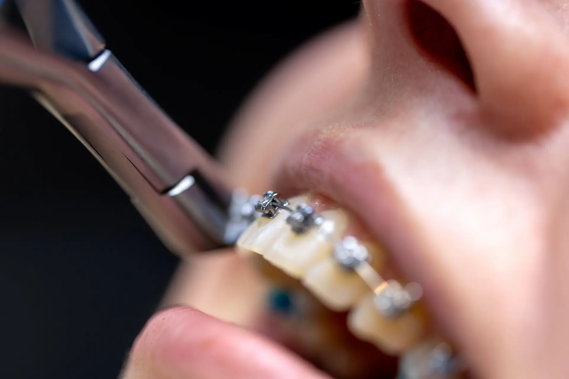 Etapele tratamentului cu aparat dentar metalic