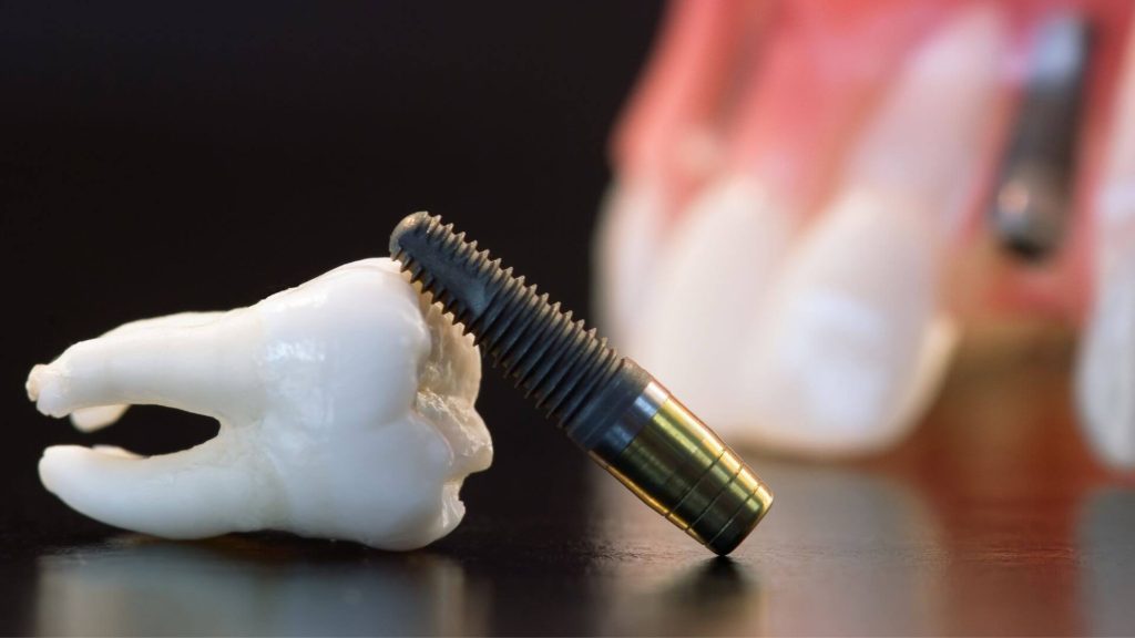 extractia implantului dentar