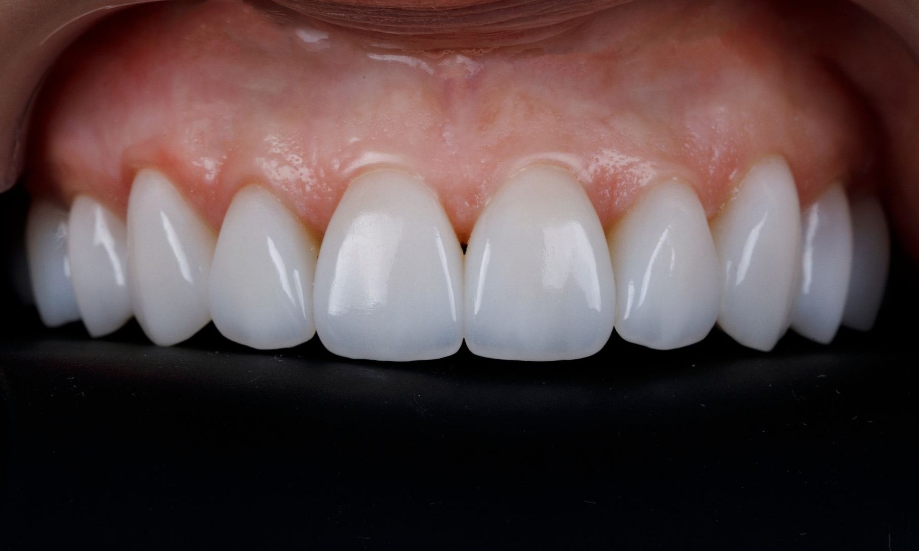 fatete dentare