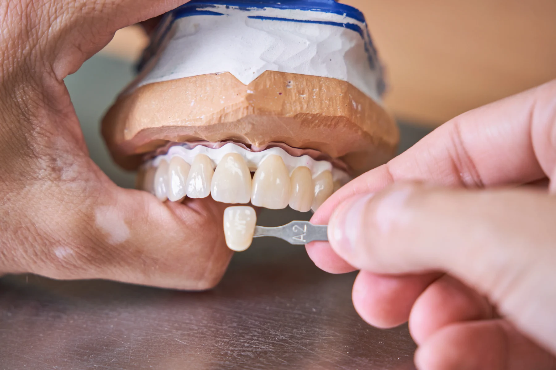 fatete dentare zirconiu etape