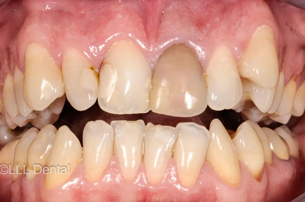 fatete zirconiu before