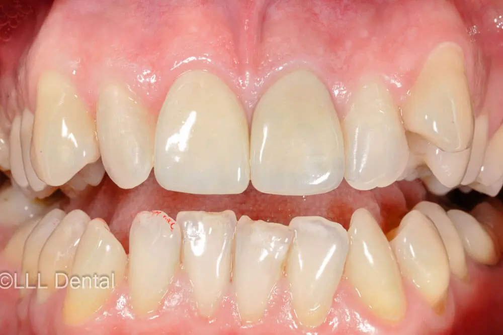 fatete zirconiu after