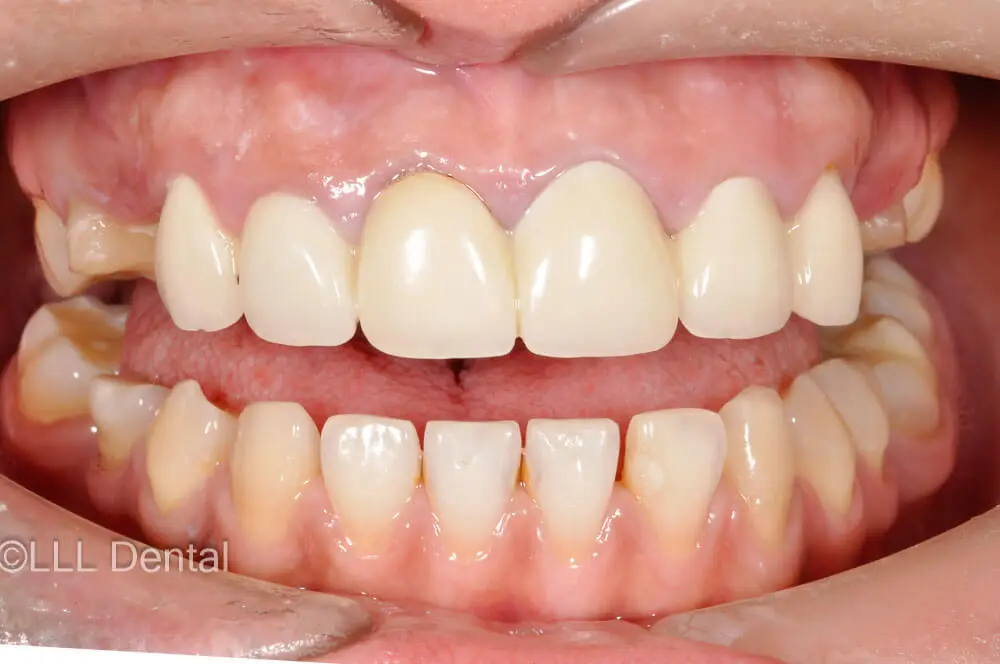 FATETE HOLYWOOD FRONT SI PUNTI ZR LATERALE BEFORE