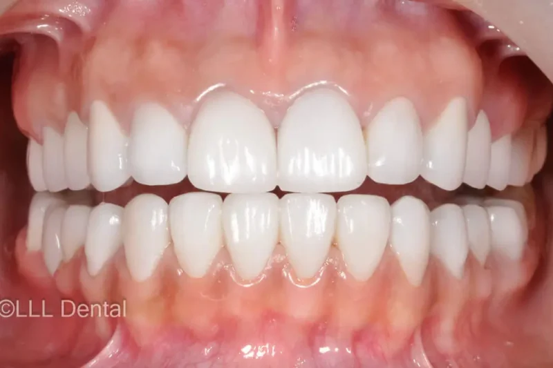 fatete dentare before and after