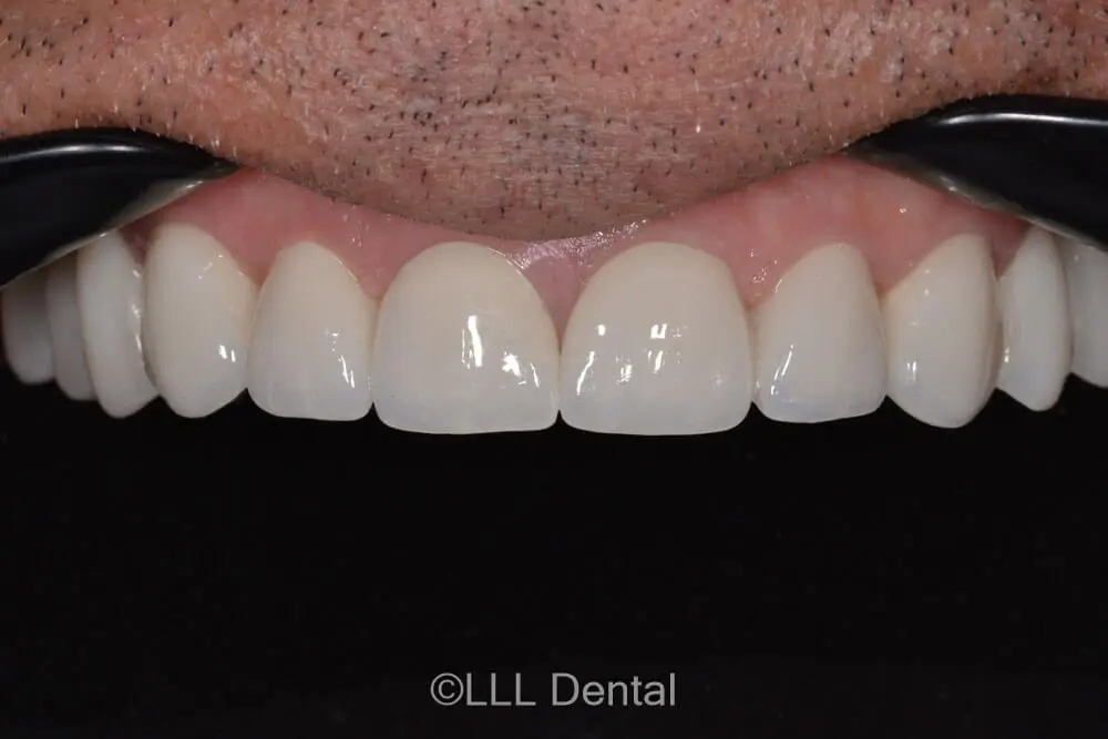 FATETE NO PREP AFTER