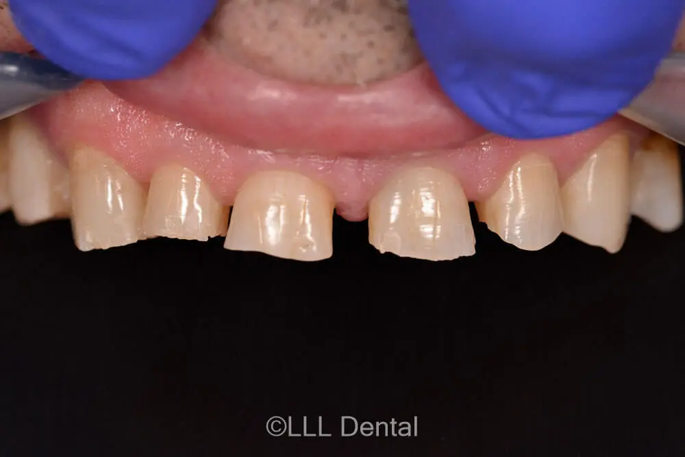 FATETE NO PREP BEFORE