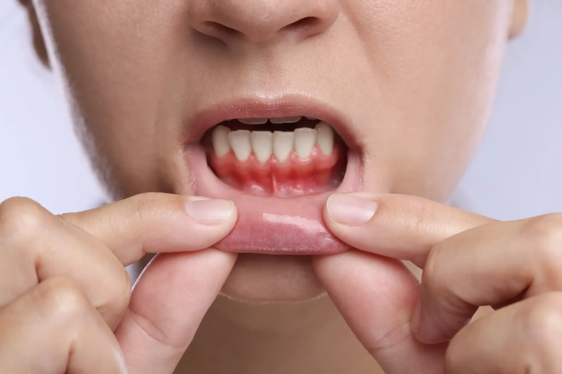 gingii inflamate