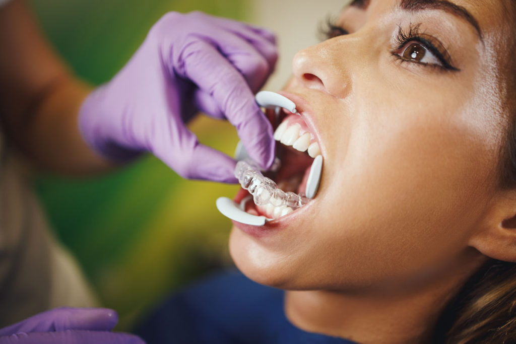gutiera dentara pentru indreptarea dintilor
