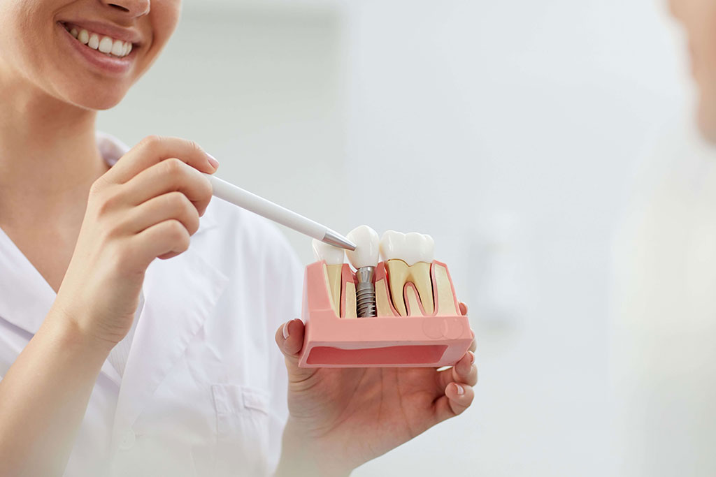 Avantajele implantului dentar rapid