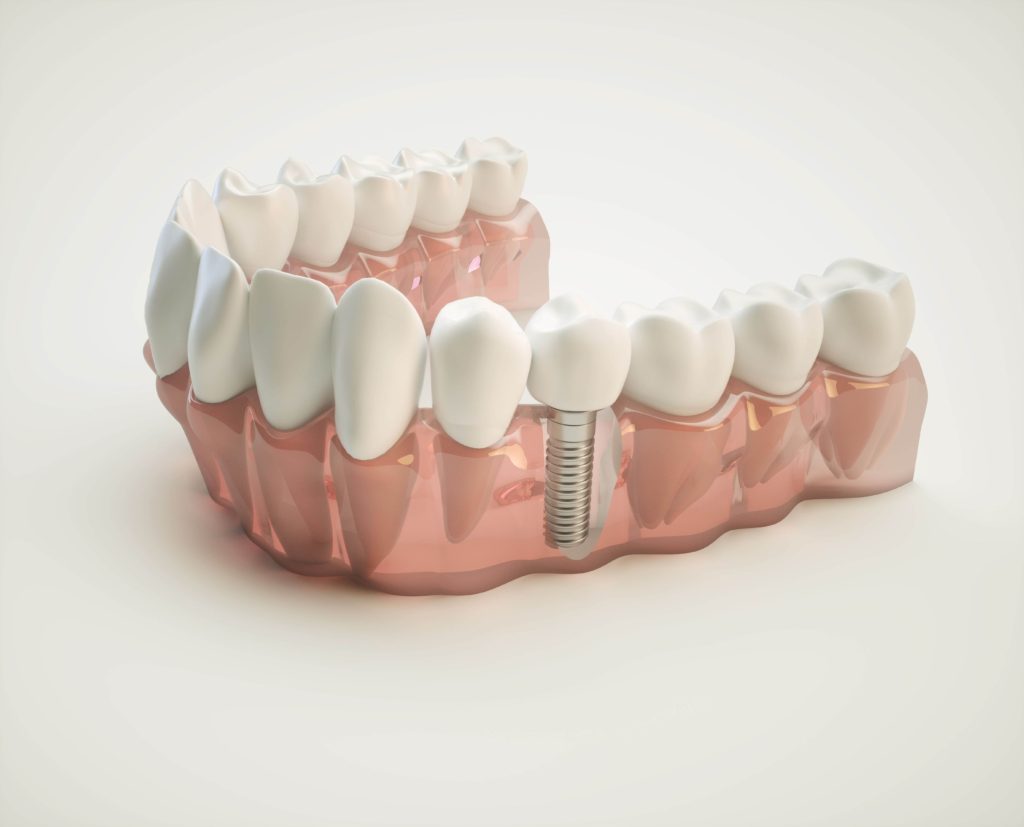 implant dentar si aditie de os