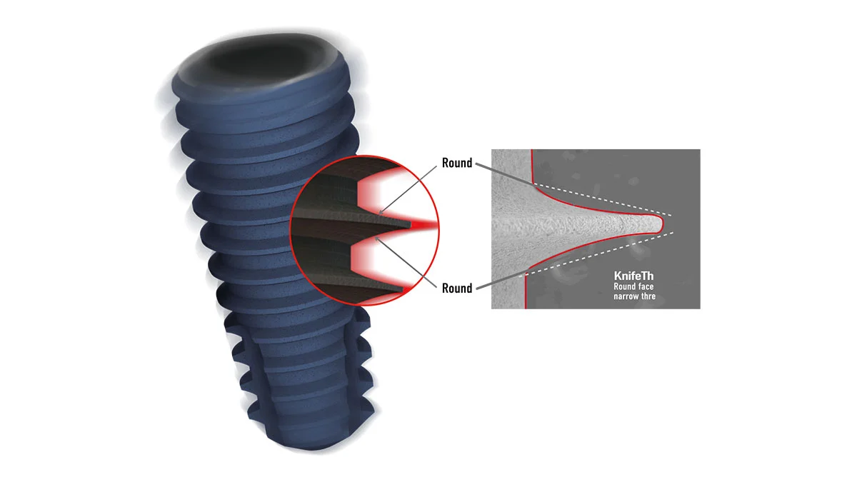 Când recomandă medicul implantul Megagen?