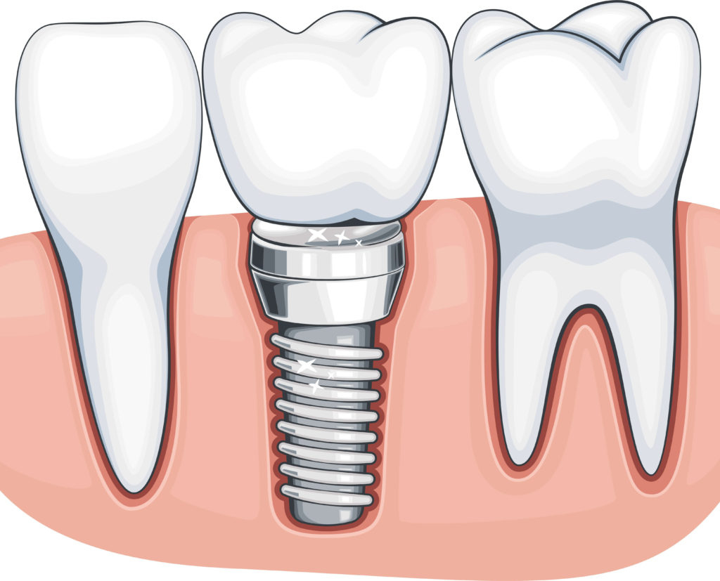 implantul dentar